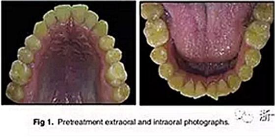 文獻優(yōu)秀正畸病例賞析-通過微種植釘及多曲方絲技術(shù)壓低下頜磨牙非手術(shù)矯治嚴(yán)重前牙開合患者1例 文獻優(yōu)秀正畸病例賞析-通過微種植釘及多曲方絲技術(shù)壓低下頜磨牙非手術(shù)矯治嚴(yán)重前牙開合患者1例