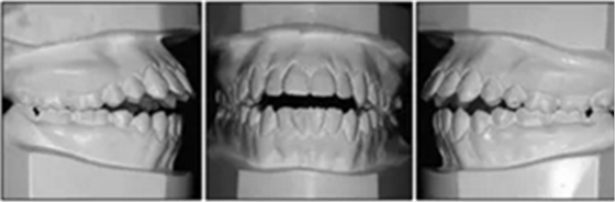 文獻優(yōu)秀正畸病例賞析-通過微種植釘及多曲方絲技術(shù)壓低下頜磨牙非手術(shù)矯治嚴(yán)重前牙開合患者1例 文獻優(yōu)秀正畸病例賞析-通過微種植釘及多曲方絲技術(shù)壓低下頜磨牙非手術(shù)矯治嚴(yán)重前牙開合患者1例