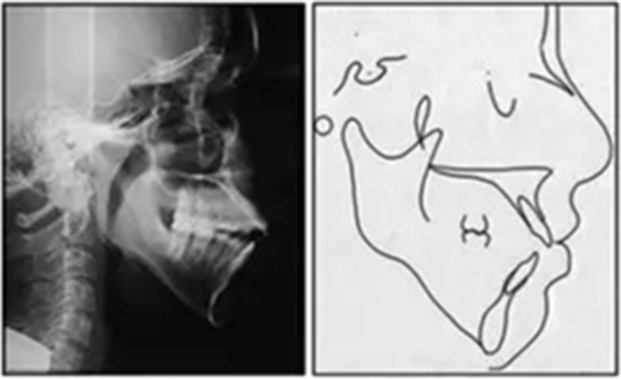 文獻優(yōu)秀正畸病例賞析-通過微種植釘及多曲方絲技術(shù)壓低下頜磨牙非手術(shù)矯治嚴(yán)重前牙開合患者1例 文獻優(yōu)秀正畸病例賞析-通過微種植釘及多曲方絲技術(shù)壓低下頜磨牙非手術(shù)矯治嚴(yán)重前牙開合患者1例