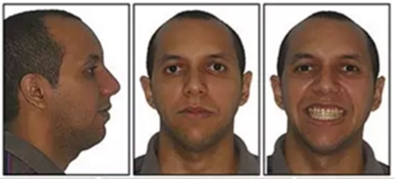 文獻優(yōu)秀正畸病例賞析-通過微種植釘及多曲方絲技術(shù)壓低下頜磨牙非手術(shù)矯治嚴(yán)重前牙開合患者1例 文獻優(yōu)秀正畸病例賞析-通過微種植釘及多曲方絲技術(shù)壓低下頜磨牙非手術(shù)矯治嚴(yán)重前牙開合患者1例