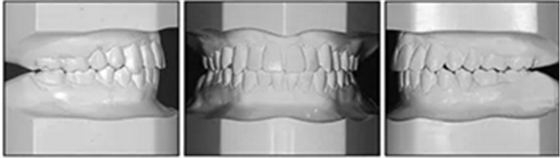 文獻優(yōu)秀正畸病例賞析-通過微種植釘及多曲方絲技術(shù)壓低下頜磨牙非手術(shù)矯治嚴(yán)重前牙開合患者1例 文獻優(yōu)秀正畸病例賞析-通過微種植釘及多曲方絲技術(shù)壓低下頜磨牙非手術(shù)矯治嚴(yán)重前牙開合患者1例