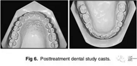 文獻優(yōu)秀正畸病例賞析-通過微種植釘及多曲方絲技術(shù)壓低下頜磨牙非手術(shù)矯治嚴(yán)重前牙開合患者1例 文獻優(yōu)秀正畸病例賞析-通過微種植釘及多曲方絲技術(shù)壓低下頜磨牙非手術(shù)矯治嚴(yán)重前牙開合患者1例