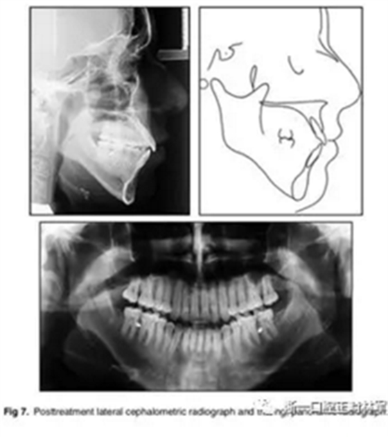 文獻優(yōu)秀正畸病例賞析-通過微種植釘及多曲方絲技術(shù)壓低下頜磨牙非手術(shù)矯治嚴(yán)重前牙開合患者1例 文獻優(yōu)秀正畸病例賞析-通過微種植釘及多曲方絲技術(shù)壓低下頜磨牙非手術(shù)矯治嚴(yán)重前牙開合患者1例