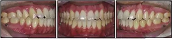 文獻優(yōu)秀正畸病例賞析-通過微種植釘及多曲方絲技術(shù)壓低下頜磨牙非手術(shù)矯治嚴(yán)重前牙開合患者1例 文獻優(yōu)秀正畸病例賞析-通過微種植釘及多曲方絲技術(shù)壓低下頜磨牙非手術(shù)矯治嚴(yán)重前牙開合患者1例