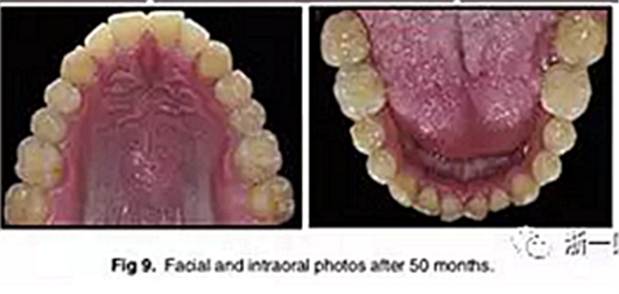 文獻優(yōu)秀正畸病例賞析-通過微種植釘及多曲方絲技術(shù)壓低下頜磨牙非手術(shù)矯治嚴(yán)重前牙開合患者1例 文獻優(yōu)秀正畸病例賞析-通過微種植釘及多曲方絲技術(shù)壓低下頜磨牙非手術(shù)矯治嚴(yán)重前牙開合患者1例