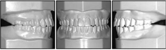 文獻優(yōu)秀正畸病例賞析-通過微種植釘及多曲方絲技術(shù)壓低下頜磨牙非手術(shù)矯治嚴(yán)重前牙開合患者1例 文獻優(yōu)秀正畸病例賞析-通過微種植釘及多曲方絲技術(shù)壓低下頜磨牙非手術(shù)矯治嚴(yán)重前牙開合患者1例