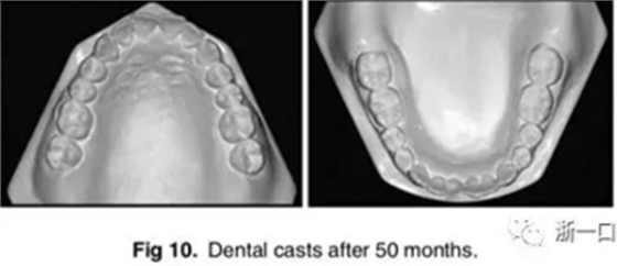文獻優(yōu)秀正畸病例賞析-通過微種植釘及多曲方絲技術(shù)壓低下頜磨牙非手術(shù)矯治嚴(yán)重前牙開合患者1例 文獻優(yōu)秀正畸病例賞析-通過微種植釘及多曲方絲技術(shù)壓低下頜磨牙非手術(shù)矯治嚴(yán)重前牙開合患者1例