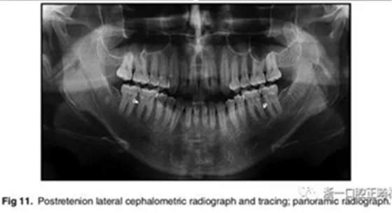 文獻優(yōu)秀正畸病例賞析-通過微種植釘及多曲方絲技術(shù)壓低下頜磨牙非手術(shù)矯治嚴(yán)重前牙開合患者1例 文獻優(yōu)秀正畸病例賞析-通過微種植釘及多曲方絲技術(shù)壓低下頜磨牙非手術(shù)矯治嚴(yán)重前牙開合患者1例
