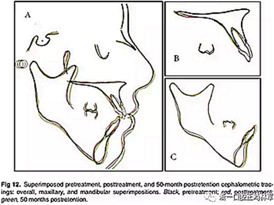 文獻優(yōu)秀正畸病例賞析-通過微種植釘及多曲方絲技術(shù)壓低下頜磨牙非手術(shù)矯治嚴(yán)重前牙開合患者1例 文獻優(yōu)秀正畸病例賞析-通過微種植釘及多曲方絲技術(shù)壓低下頜磨牙非手術(shù)矯治嚴(yán)重前牙開合患者1例