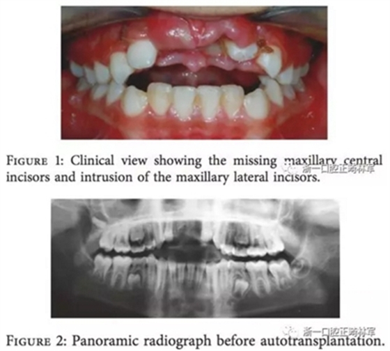 文獻優(yōu)秀正畸病例賞析--上頜中切牙區(qū)受傷后自體牙移植及正畸治療13年隨訪病例 文獻優(yōu)秀正畸病例賞析--上頜中切牙區(qū)受傷后自體牙移植及正畸治療13年隨訪病例
