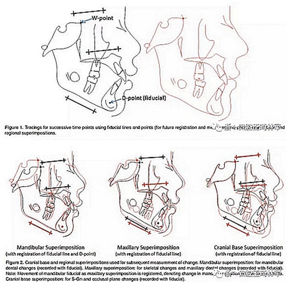 正畸文獻(xiàn)閱讀--不同頸椎成熟狀態(tài)使用Forsus矯治器治療II類患者的矯治效果比較 正畸文獻(xiàn)閱讀--不同頸椎成熟狀態(tài)使用Forsus矯治器治療II類患者的矯治效果比較