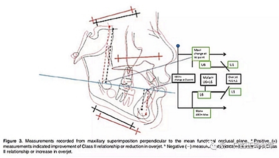 正畸文獻(xiàn)閱讀--不同頸椎成熟狀態(tài)使用Forsus矯治器治療II類患者的矯治效果比較 正畸文獻(xiàn)閱讀--不同頸椎成熟狀態(tài)使用Forsus矯治器治療II類患者的矯治效果比較