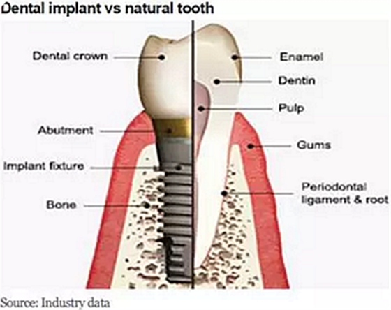 種植體，在全球牙科設(shè)備市場(chǎng)的變化！