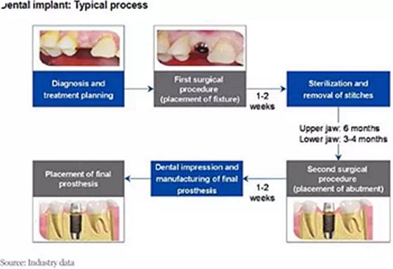 種植體，在全球牙科設(shè)備市場(chǎng)的變化！