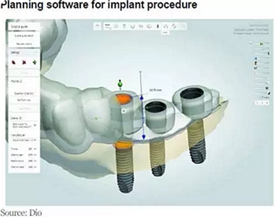 種植體，在全球牙科設(shè)備市場(chǎng)的變化！