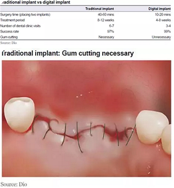 種植體，在全球牙科設(shè)備市場(chǎng)的變化！
