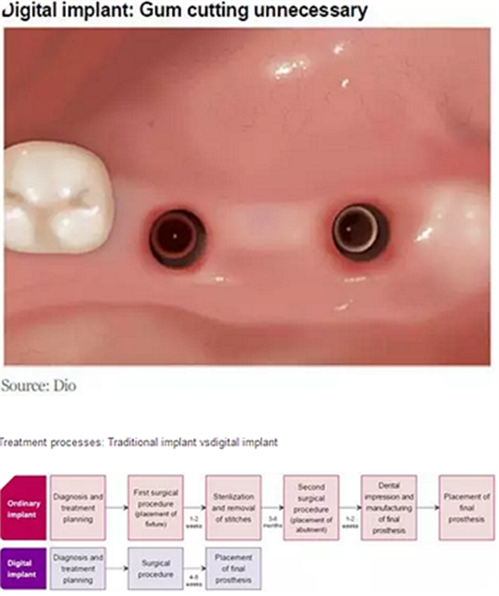 種植體，在全球牙科設(shè)備市場(chǎng)的變化！
