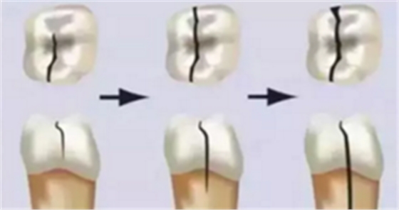 為什么有些牙齒不能拔？拔牙無小事！