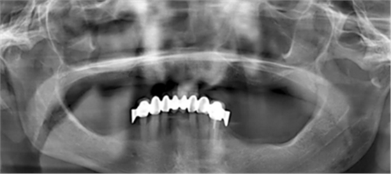 CARES?綜合的數字化解決方案---3D打印全程導板引導下植入病例一例 CARES?綜合的數字化解決方案---3D打印全程導板引導下植入病例一例
