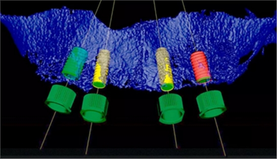 CARES?綜合的數字化解決方案---3D打印全程導板引導下植入病例一例 CARES?綜合的數字化解決方案---3D打印全程導板引導下植入病例一例