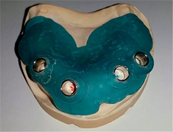 CARES?綜合的數字化解決方案---3D打印全程導板引導下植入病例一例 CARES?綜合的數字化解決方案---3D打印全程導板引導下植入病例一例