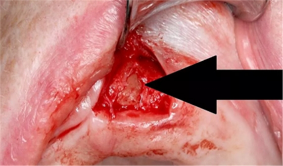 CARES?綜合的數字化解決方案---3D打印全程導板引導下植入病例一例 CARES?綜合的數字化解決方案---3D打印全程導板引導下植入病例一例