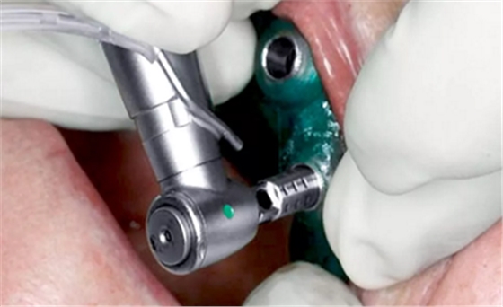 CARES?綜合的數字化解決方案---3D打印全程導板引導下植入病例一例 CARES?綜合的數字化解決方案---3D打印全程導板引導下植入病例一例