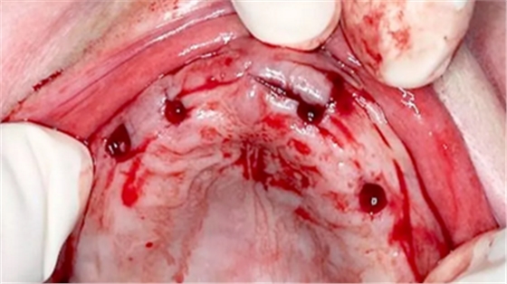 CARES?綜合的數字化解決方案---3D打印全程導板引導下植入病例一例 CARES?綜合的數字化解決方案---3D打印全程導板引導下植入病例一例