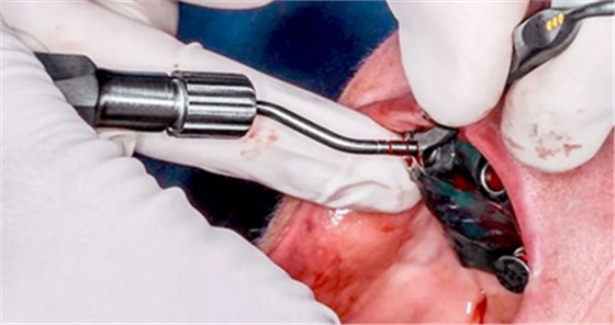 CARES?綜合的數字化解決方案---3D打印全程導板引導下植入病例一例 CARES?綜合的數字化解決方案---3D打印全程導板引導下植入病例一例