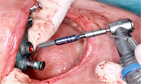 CARES?綜合的數字化解決方案---3D打印全程導板引導下植入病例一例 CARES?綜合的數字化解決方案---3D打印全程導板引導下植入病例一例