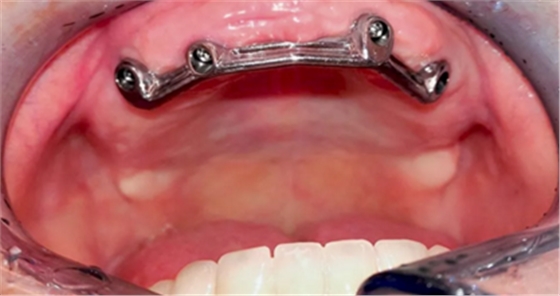 CARES?綜合的數字化解決方案---3D打印全程導板引導下植入病例一例 CARES?綜合的數字化解決方案---3D打印全程導板引導下植入病例一例