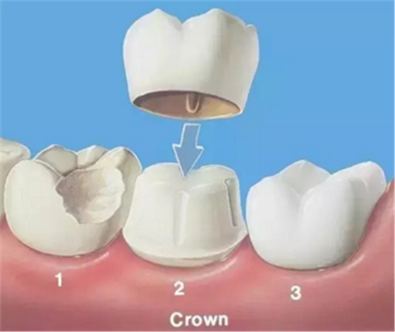 完全不懂，各種補(bǔ)牙材料，到底怎么選？