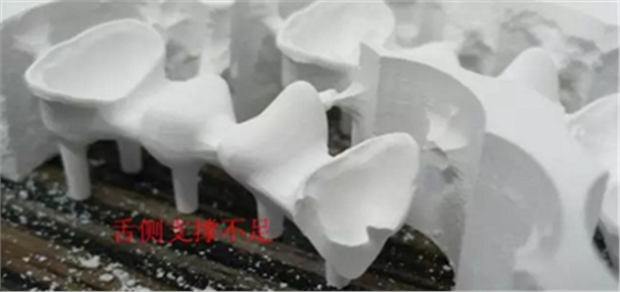 全鋯牙冠裂原因分析—操作流程工藝以及患者日常使用 全鋯牙冠裂原因分析—操作流程工藝以及患者日常使用