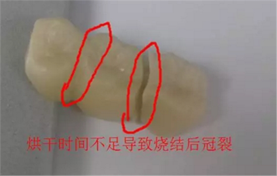 全鋯牙冠裂原因分析—操作流程工藝以及患者日常使用 全鋯牙冠裂原因分析—操作流程工藝以及患者日常使用