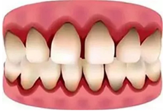 最可怕的牙病——牙齦萎縮 最可怕的牙病——牙齦萎縮