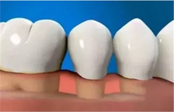 最可怕的牙病——牙齦萎縮 最可怕的牙病——牙齦萎縮