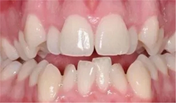 最可怕的牙病——牙齦萎縮 最可怕的牙病——牙齦萎縮