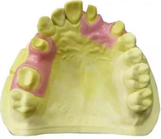 【分享】高水平義齒制作工藝流程 【分享】高水平義齒制作工藝流程