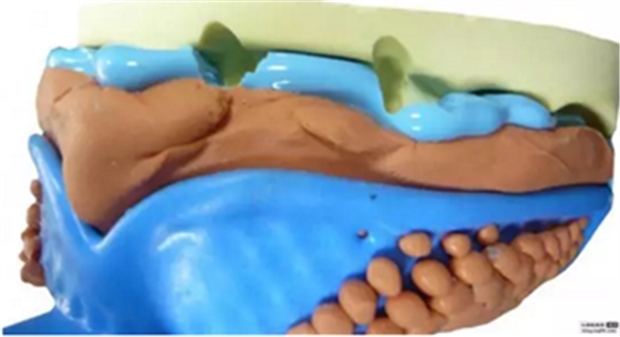 【分享】高水平義齒制作工藝流程 【分享】高水平義齒制作工藝流程