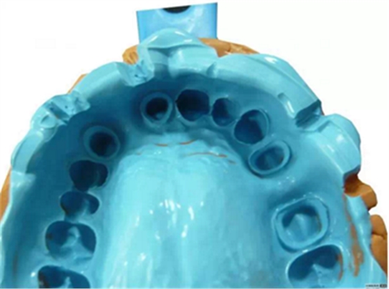 【分享】高水平義齒制作工藝流程 【分享】高水平義齒制作工藝流程