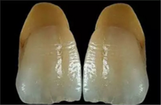 【分享】高水平義齒制作工藝流程 【分享】高水平義齒制作工藝流程