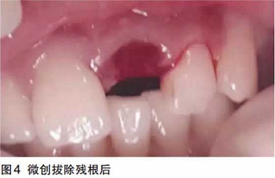 前牙即刻種植并個(gè)性化基臺(tái)美學(xué)修復(fù) 前牙即刻種植并個(gè)性化基臺(tái)美學(xué)修復(fù)