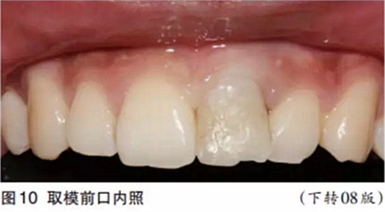 前牙即刻種植并個(gè)性化基臺(tái)美學(xué)修復(fù) 前牙即刻種植并個(gè)性化基臺(tái)美學(xué)修復(fù)