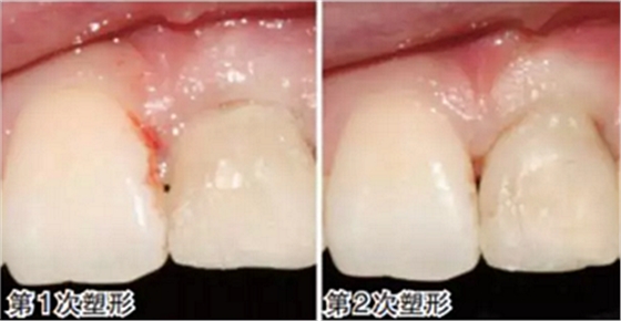 前牙即刻種植并個(gè)性化基臺(tái)美學(xué)修復(fù) 前牙即刻種植并個(gè)性化基臺(tái)美學(xué)修復(fù)