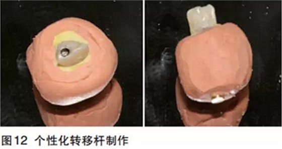 前牙即刻種植并個(gè)性化基臺(tái)美學(xué)修復(fù) 前牙即刻種植并個(gè)性化基臺(tái)美學(xué)修復(fù)