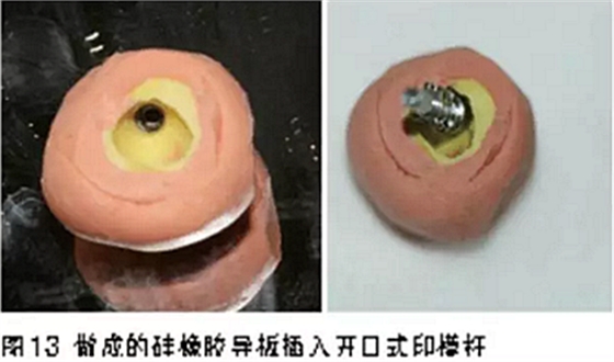 前牙即刻種植并個(gè)性化基臺(tái)美學(xué)修復(fù) 前牙即刻種植并個(gè)性化基臺(tái)美學(xué)修復(fù)