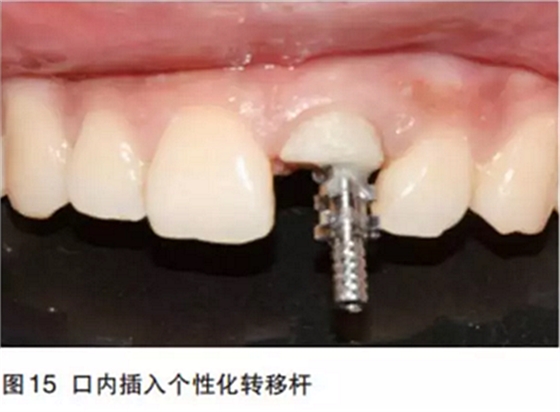 前牙即刻種植并個(gè)性化基臺(tái)美學(xué)修復(fù) 前牙即刻種植并個(gè)性化基臺(tái)美學(xué)修復(fù)