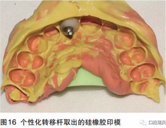 前牙即刻種植并個(gè)性化基臺(tái)美學(xué)修復(fù) 前牙即刻種植并個(gè)性化基臺(tái)美學(xué)修復(fù)