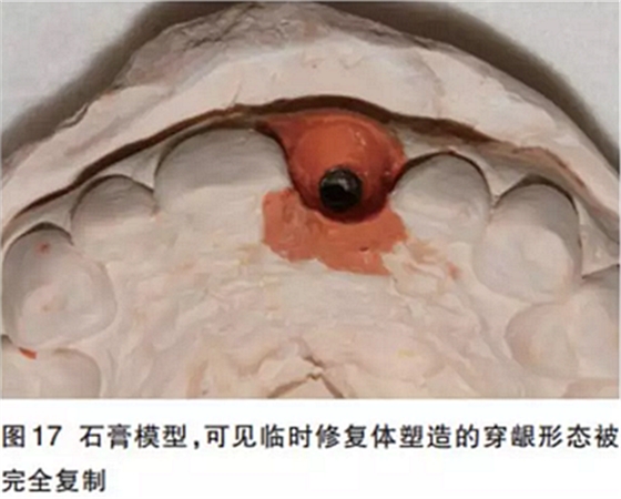 前牙即刻種植并個(gè)性化基臺(tái)美學(xué)修復(fù) 前牙即刻種植并個(gè)性化基臺(tái)美學(xué)修復(fù)