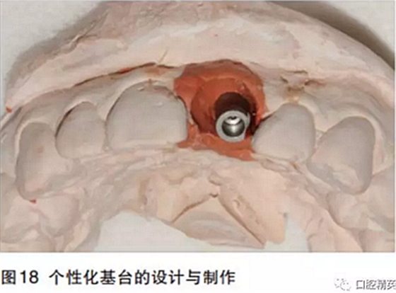 前牙即刻種植并個(gè)性化基臺(tái)美學(xué)修復(fù) 前牙即刻種植并個(gè)性化基臺(tái)美學(xué)修復(fù)